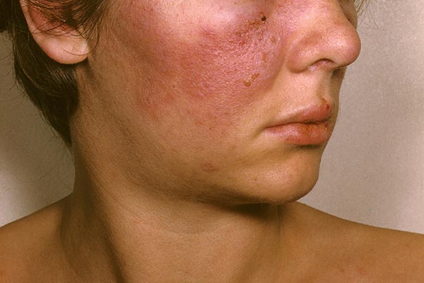 آیا بیماری شوگرن خطرناک است