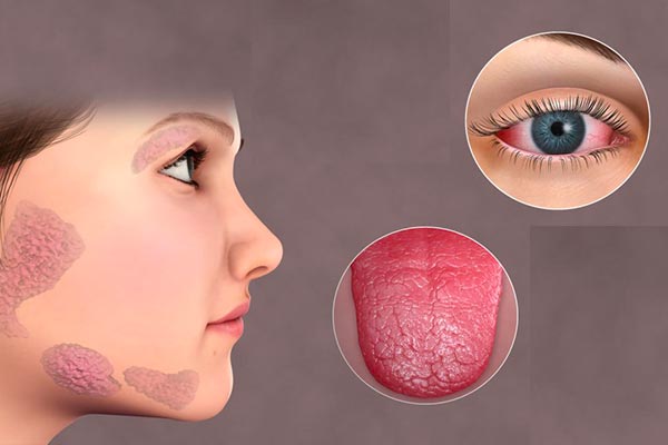 انواع سندرم شوگرن