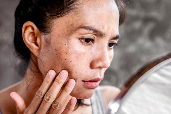 غدد فوق کلیوی و ریزش مو