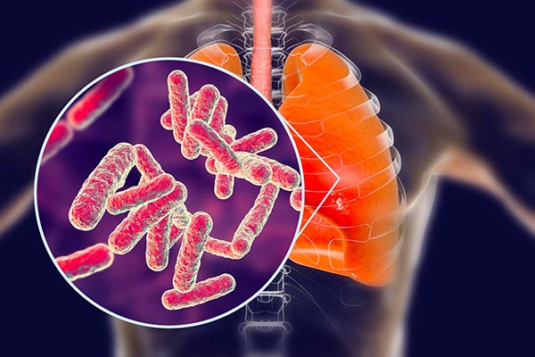 ایا بیماری سل قابل برگشت است