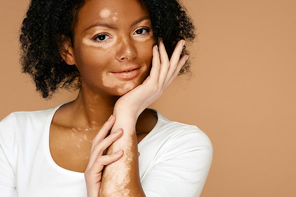 چگونه لکه های سفید صورت را از بین ببریم