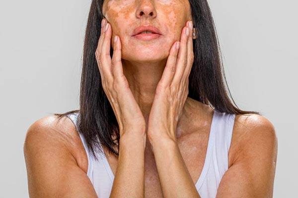 بیماری پیسی و ازدواج