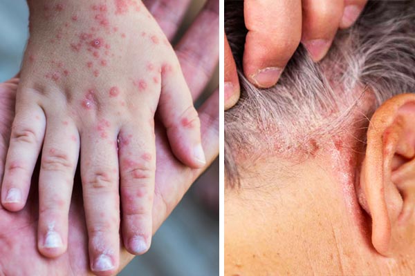 What-are-the-symptoms-of-psoriasis